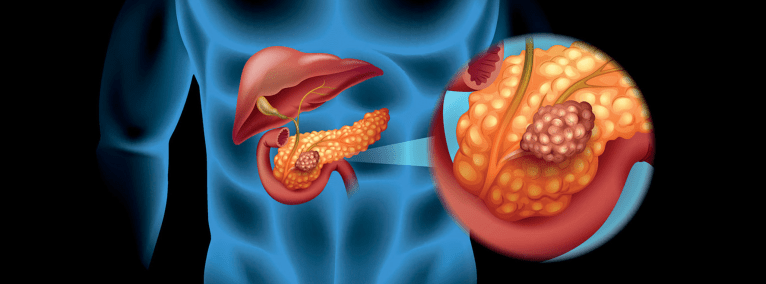 Científicos están encontrando la manera de combatir el cáncer de páncreas