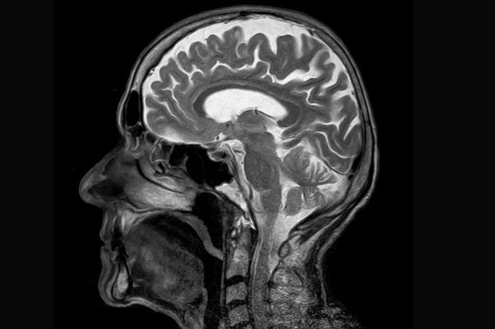 Neurocientíficos buscan responder preguntas claves como cuántas personas tienen estas afecciones, quién está en riesgo y por qué aparecen estos síntomas.