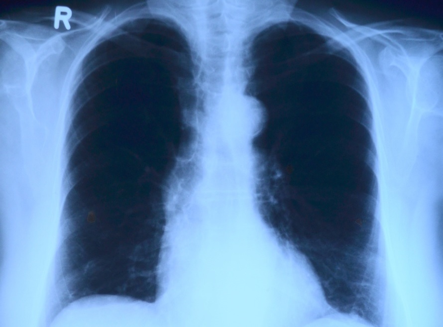 En 2022, el cáncer que más muertes causó fue el de pulmón.