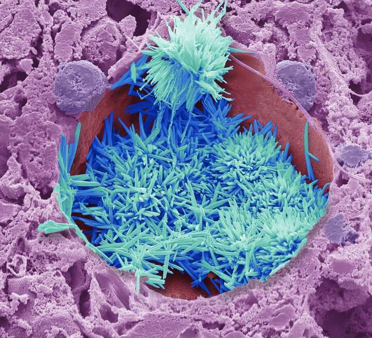 El hígado es el órgano que produce y controla los niveles de colesterol en el cuerpo. Esta imagen muestra cristales de colesterol (azul) dentro de una célula hepática cargada de lípidos (morada) extraída de un hígado humano. Cuando el colesterol pasa de líquido a cristal, puede acumularse en el sistema circulatorio y causar daño a los vasos sanguíneos, lo que puede provocar infartos y accidentes cerebrovasculares. Steve Gschmeissner, fotógrafo científico, creó la imagen mediante una técnica llamada microscopía electrónica, que permite visualizar estructuras extremadamente pequeñas con una resolución muy alta. El coloreado de la imagen resultante resalta las diferentes estructuras dentro de ella. Imágenes tan detalladas como estas pueden ayudar a los científicos y al público en general a comprender mejor los efectos del colesterol en el organismo.