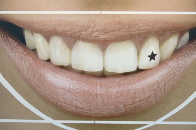 Tatuajes dentales permanentes, estética agresiva