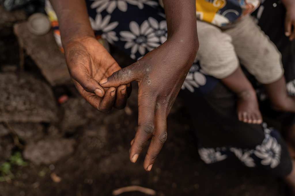 Mudja (Democratic Republic Of Congo), 20/08/2024.- Tuliza Bisere shows her hands as she holds her daughter Ishara who was cured of mpox but still shows scars of the disease in the camp for internal displaced persons in Mudja, Democratic Republic of Congo, 20 August 2024. Democratic Republic of Congo'Äôs Health Minister Samuel-Boger Kamba said the death toll due to the mpox outbreak now stands at 'a little more than 570 deaths.' The World Health Organization has declared the rise in mpox cases in the Democratic Republic of the Congo and neighboring countries a public health emergency, with over 27,000 cases and more than 1,100 deaths reported since January 2023. Symptoms include fever, body aches, and rashes, and while there is no specific treatment for mpox, supportive care can aid recovery. The virus spreads through close contact with infected individuals and can persist on contaminated surfaces. EFE/EPA/MOISE KASEREKA