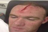 Wayne Rooney mostró su herida en la frente y acalló críticas