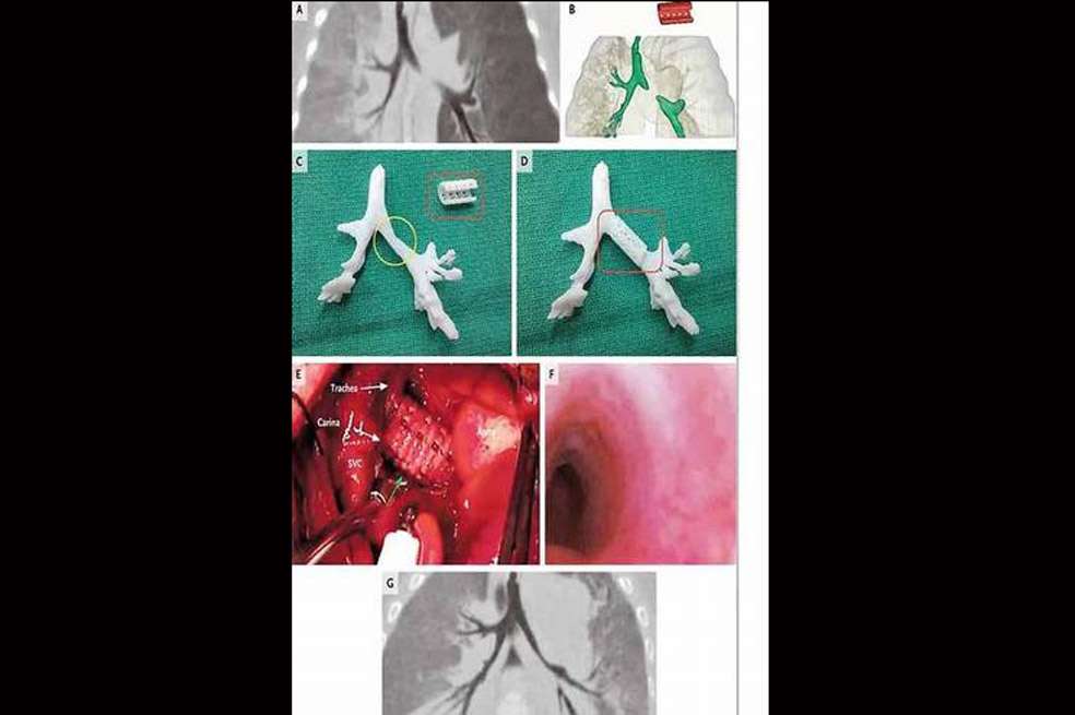 La férula fue creada con un biomaterial reabsorbible por el cuerpo en tres años.
