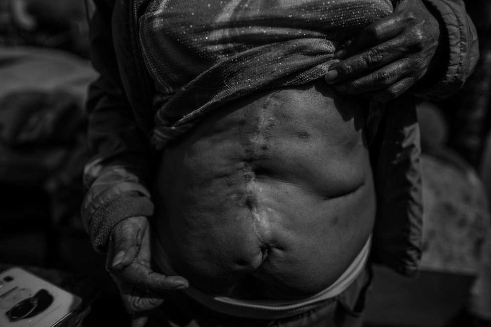 Extracción del útero, infecciones urinarias y enfermedades de transimisión sexual son algunos de los daños a la salud que sufren las víctimas en prostitución.