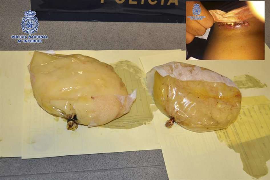 Foto cedida por la Policía Nacional de España donde muestra las prótesis mamaria incautadas./ EFE