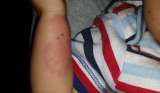 Bebé fue agredido a mordiscos por su propio padre en el sur de Bogotá