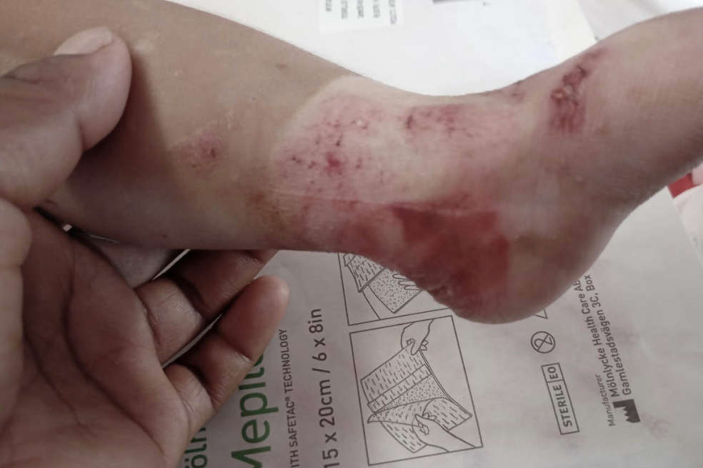 La batalla de Elian, el bebé indígena con piel de mariposa que espera sus medicamentos