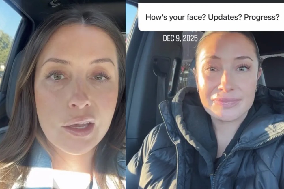 A través de su cuenta de Instagram, Bristol Palin mostró cómo quedó su cara luego de sufrir esa afectación del nervio facial.