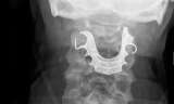 Médicos sugieren retirar dentaduras postizas antes de poner anestesia general