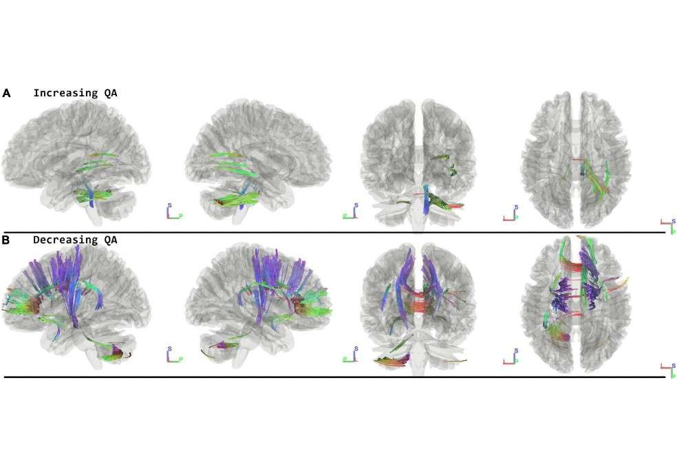 Los investigadores emplearon una técnica de imágenes cerebrales llamada tractografía de fibra, que se basa en una reconstrucción 3D. Esta técnica proporciona una especie de esquema de cableado del cerebro.