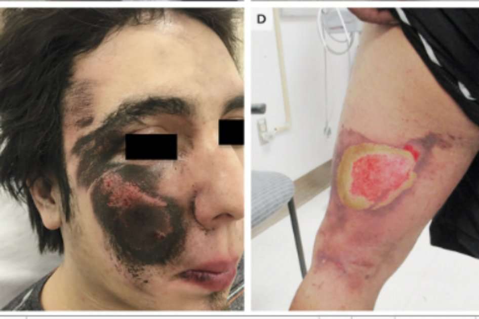 Uno de los pacientes reportados en la revista médica. / The New England Journal of Medicine.