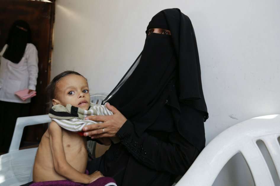 Una mujer viste a su hijo en el centro médico en Saná, donde es atendido por malnutrición. Buena parte de estos casos se deben al bloqueo que ha realizado la coalición, liderada por Arabia Saudita, en los puertos del país. / EFE