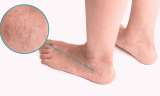 Esta receta es perfecta para reducir las venas varices de forma natural
