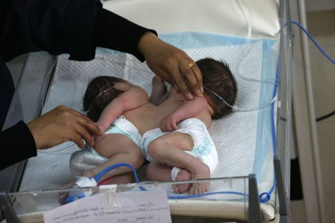 Familia busca recursos para separar a siamesas que están unidas por la cintura