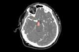 Diseñan un algoritmo que ayuda a encontrar aneurismas en el cerebro