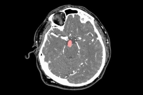 Diseñan un algoritmo que ayuda a encontrar aneurismas en el cerebro