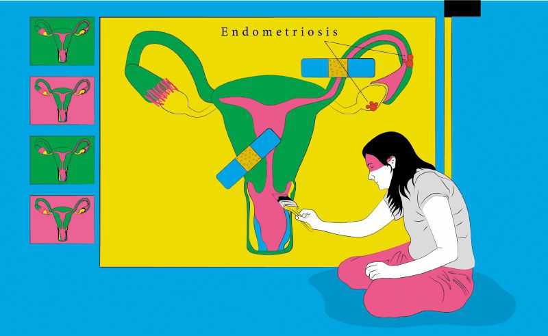 Endometriosis.