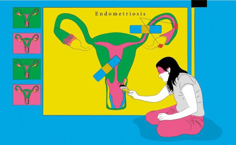 Endometriosis: cuando la normalización del dolor menstrual invisibiliza una enfermedad