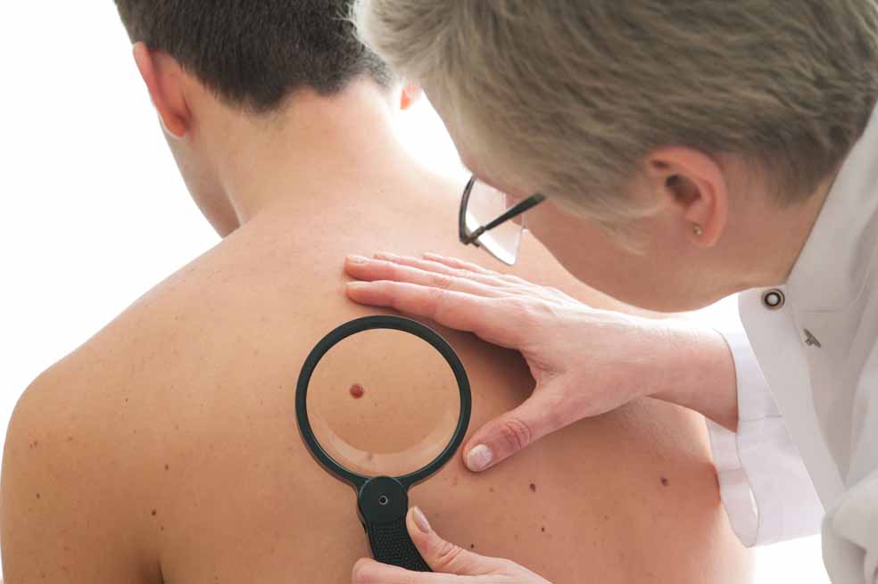 El cáncer de piel en Colombia ha aumentado de manera significativa en los últimos años. / 123 rf