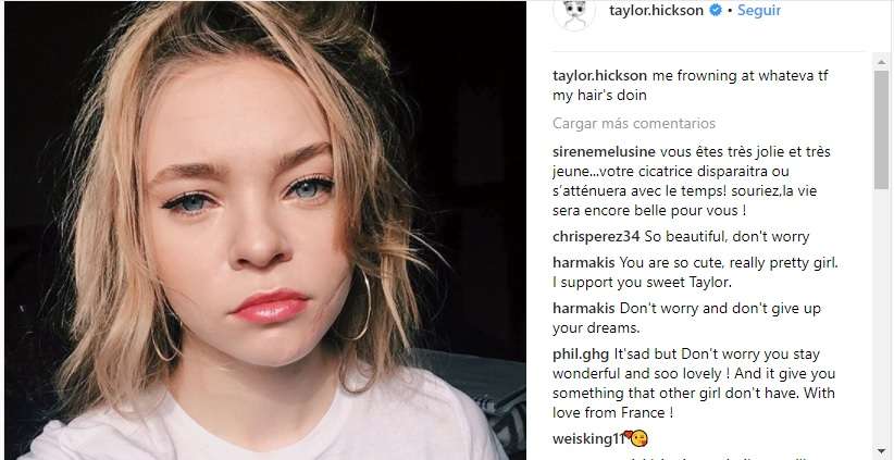 La actriz de 20 años culpa a Incident Productions de las lesiones en su rostro. / Instagram Taylor Hickson