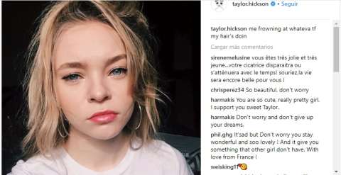 Taylor Hickson, la actriz que terminó desfigurada en rodaje de película de terror