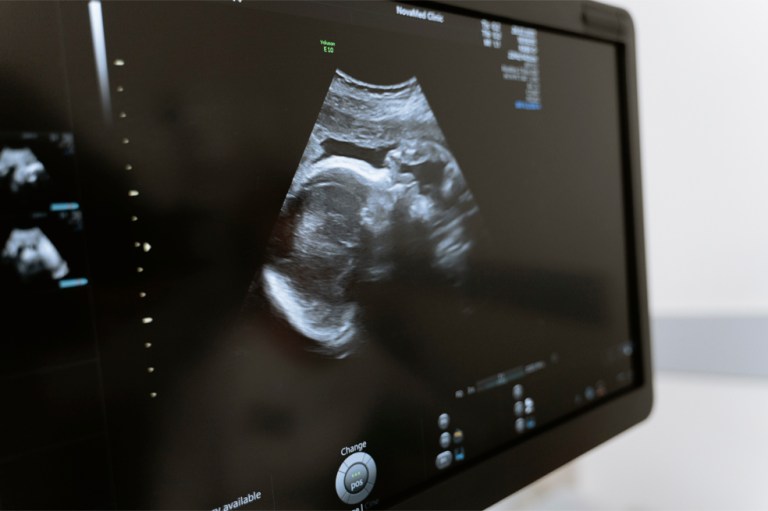 ¿Qué es un embarazo ectópico y por qué representaría la muerte inminente del bebé?