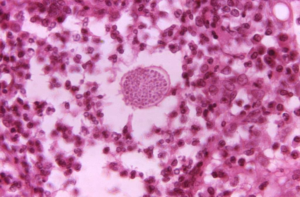 La enfermedad produce síntomas como fiebre, tos y dolor de cabeza, así como un sarpullido en partes del cuerpo.