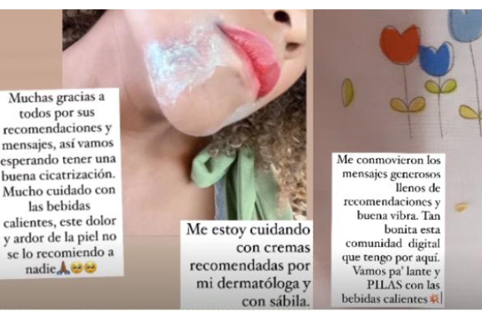 Mábel Lara se quemó el cuello.
