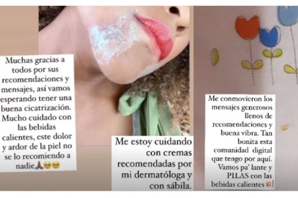 Mábel Lara se quemó el cuello.