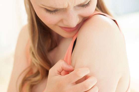 Tips para evitar y cuidar las picaduras de los mosquitos