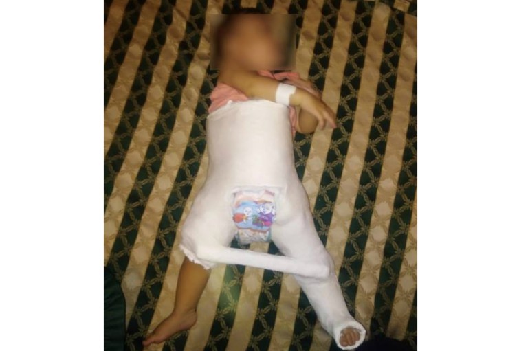 Bebé de 10 meses sufrió una terrible agresión en jardín infantil de Cali
