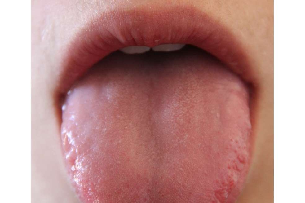 Imagen referencia - La condición puede ser causada por un efecto secundario raro de los antibióticos, mala higiene bucal, boca seca, fumar o comer una dieta de alimentos blandos.