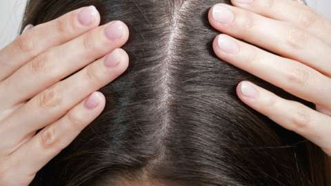 ¿Qué se hace para quitar la caspa? Consejos para tratarla si sufres de este mal