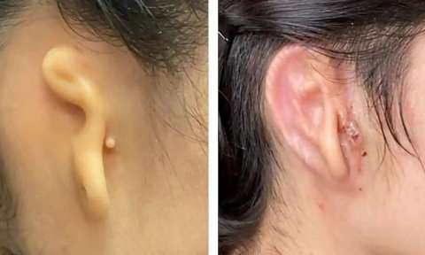Médicos estadounidenses trasplantan oreja impresa en 3D y hecha de células humanas