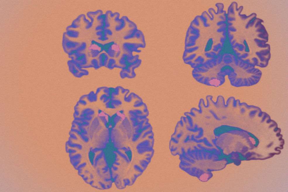 La investigación hizo parte del proyecto IMAGEN, que busca dar a luz a las relaciones entre la estructura cerebral y los trastornos mentales.
/ Simone Kühn et al. / eLife, 2019