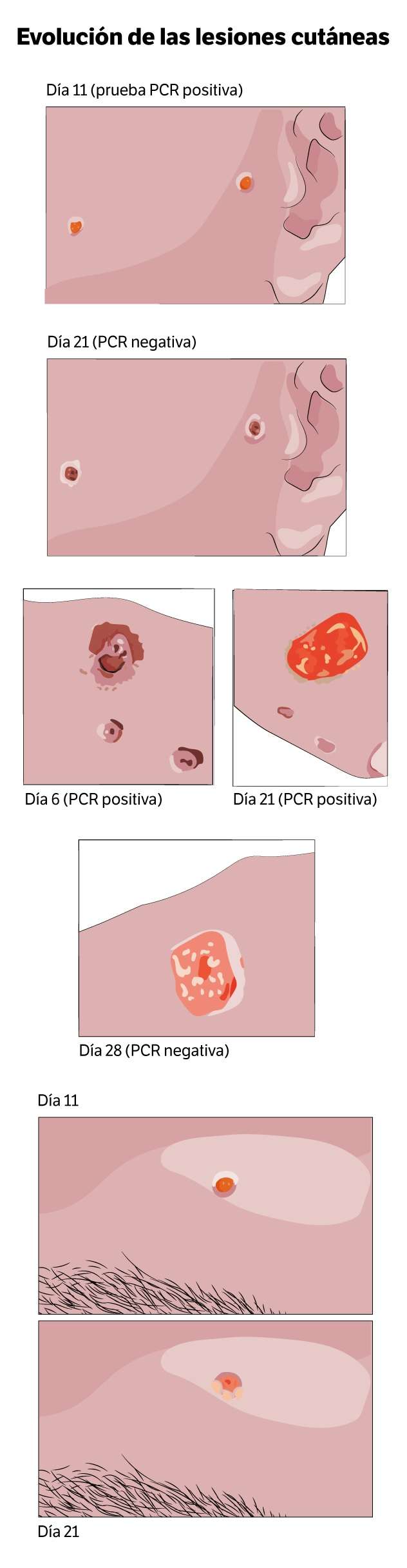 Adaptado de Thornhill et al. (2022) en New England Journal of Medicine.