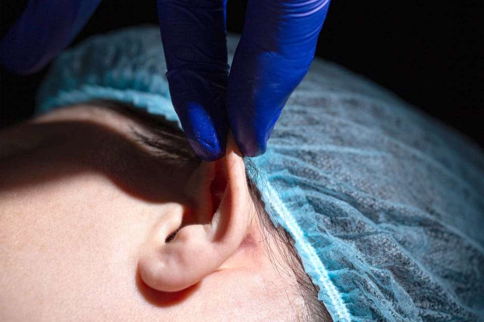Microtia