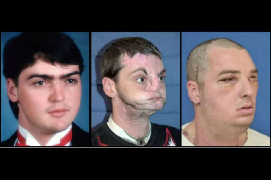 De izquierda a derecha, Joshua Aversano (donante) y Richard Norris antes y después del trasplante de rostro. / AFP