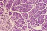 ¿Por qué el cáncer de páncreas puede ser tan agresivo? Un nuevo estudio ofrece pistas