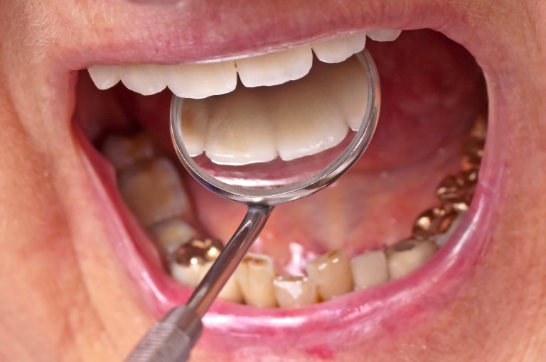 ¿Ha visto famosos con joyas en los dientes? Esta es una muy mala idea