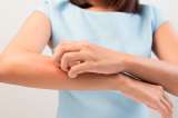 La dermatitis seborreica, la psoriasis y la seborrea: qué son y sus tratamientos