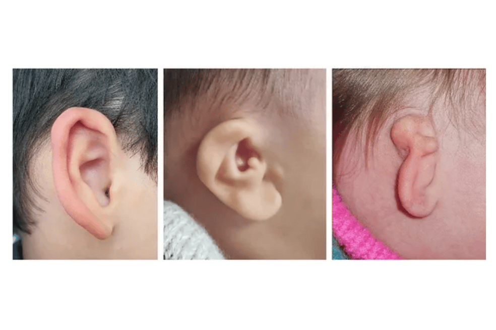 Microtia
