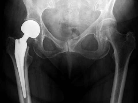 Osteoporosis en Colombia: una enfermedad masiva que sigue sin diagnosticarse a tiempo