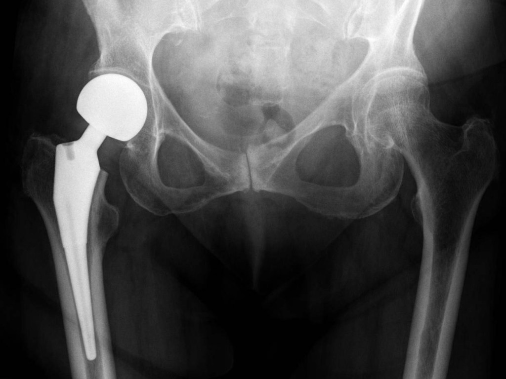 Es posible que en 2050 haya 4,5 millones de fracturas de cadera.