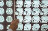 Estimulación cerebral profunda: ¿una alternativa para la depresión?